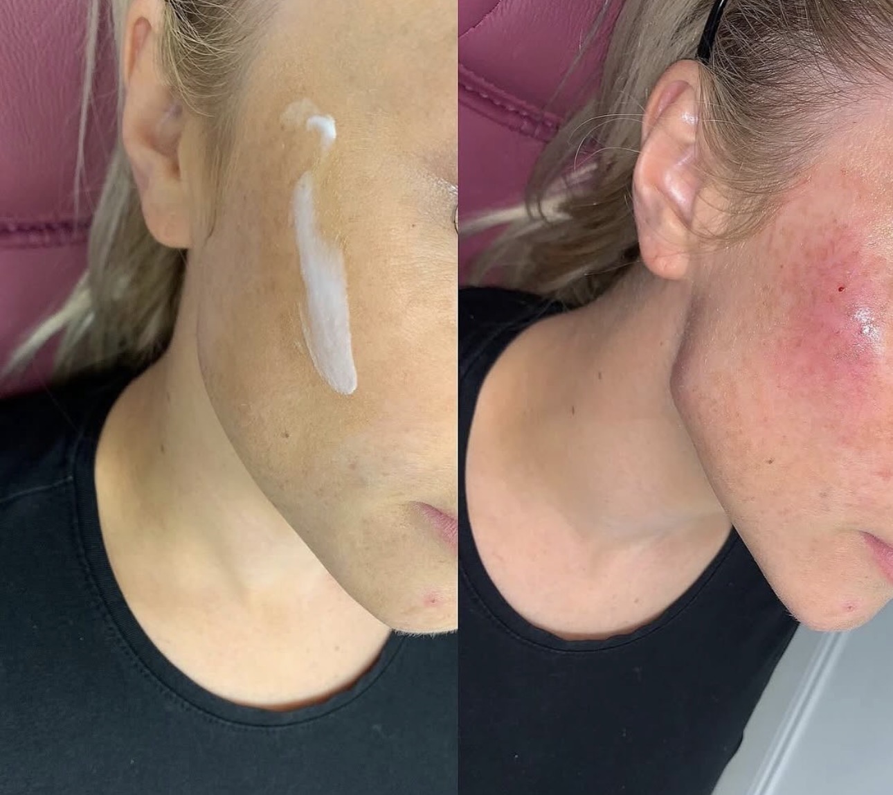 Jaw contouring result